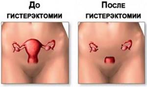 Экстирпация матки и ее осложнения